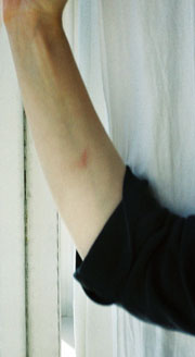 A photo of an unexplained burn on Emma Woods' right forearm on November 12, 2002.