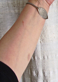 A photo of a straight cut and bruise on Emma Woods' left forearm on February 28, 2007.